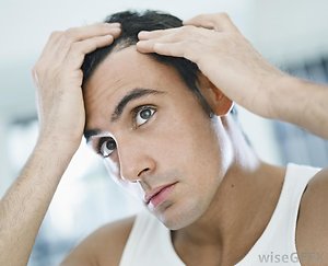 Hair loss. manhairloss